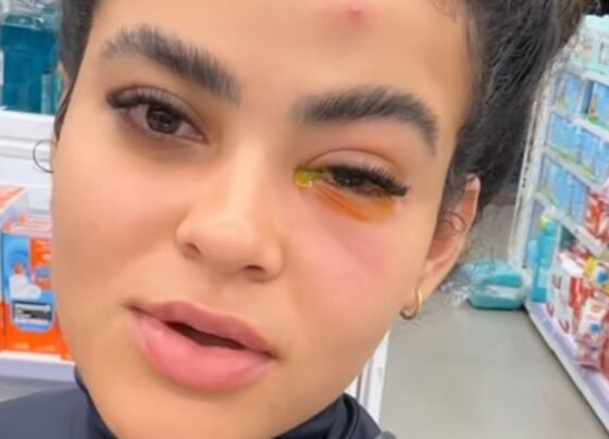 Imagem mostra mulher com o olho inchado e com um líquido amarelo - Metrópoles