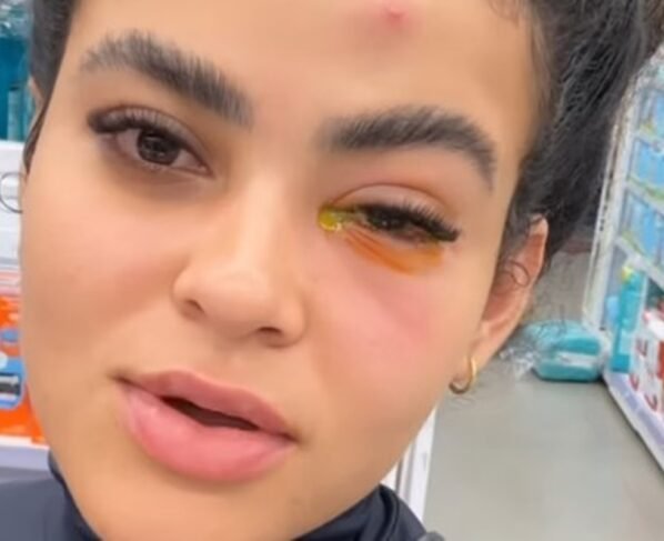 Imagem mostra mulher com o olho inchado e com um líquido amarelo - Metrópoles