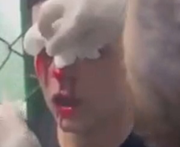 Foto colorida de jogador com olho perfurado - Metrópoles