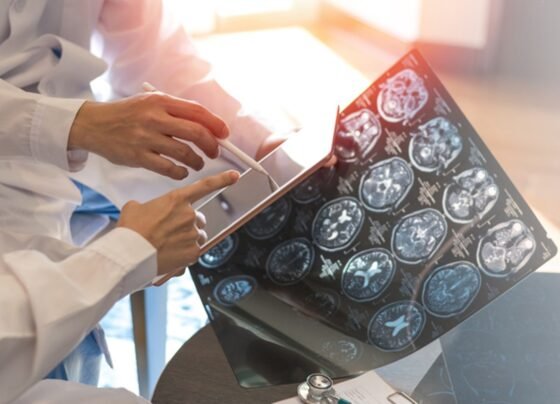 Médico aponta para raio-x com imagens de cérebro - Metrópoles - esclerose ELA