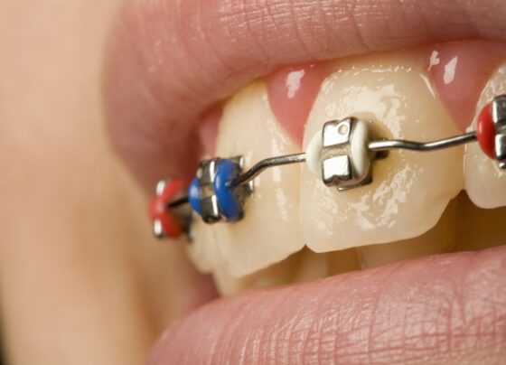 Imagem colorida de pessoa com aparelho dental - Metrópoles