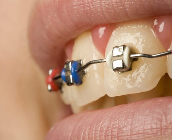 Imagem colorida de pessoa com aparelho dental - Metrópoles