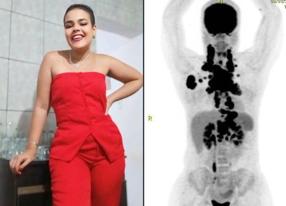 Linfoma Rafaela 24 anos (2) câncer