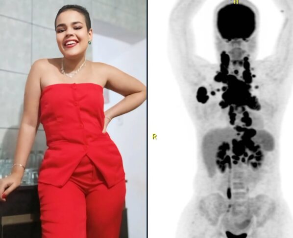 Linfoma Rafaela 24 anos (2) câncer