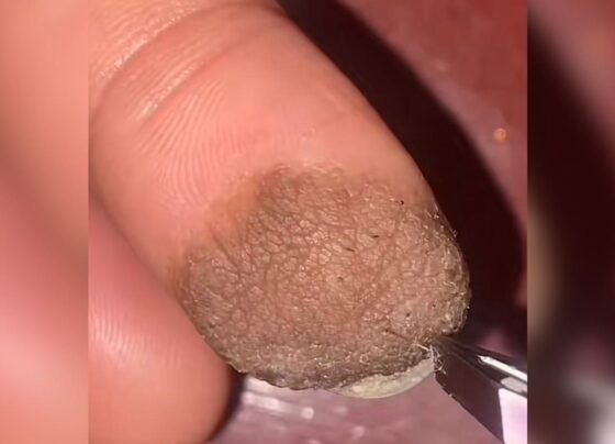 Foto colorida de dedo lesionado - Metrópoles