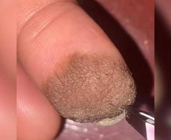 Foto colorida de dedo lesionado - Metrópoles