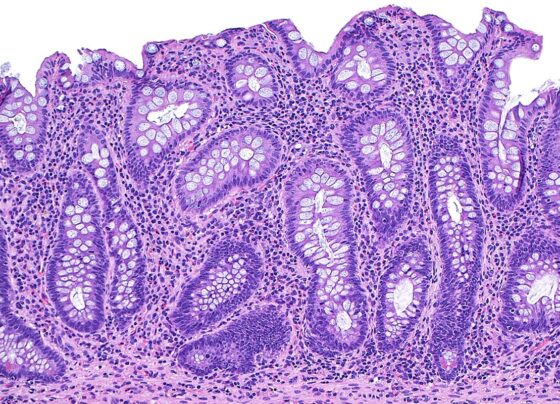 Imagem de microscópio mostra o tecido do intestino na doença inflamatória intestinal - Metrópoles