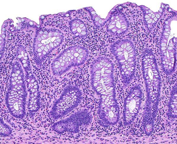 Imagem de microscópio mostra o tecido do intestino na doença inflamatória intestinal - Metrópoles