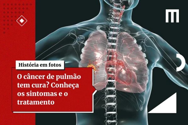 Exame de sangue pode antecipar diagnóstico do câncer de pulmão - destaque galeria