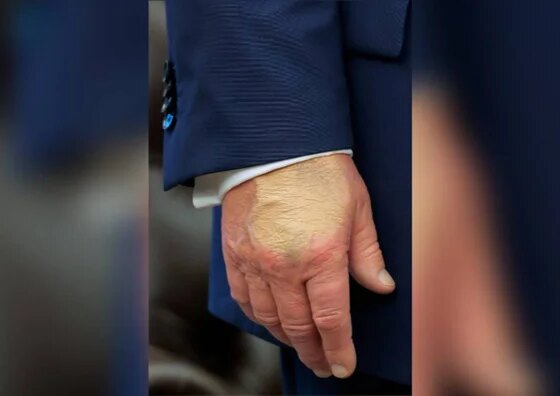 Trump precisou de curativo por conta do “excesso de apertos de mão” - destaque galeria