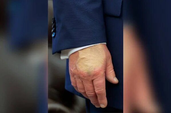 Trump precisou de curativo por conta do “excesso de apertos de mão” - destaque galeria