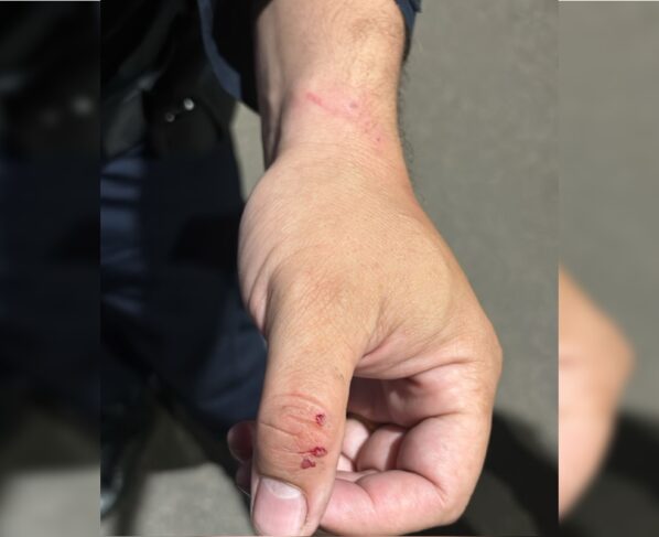 Veja como ficaram criança e policial atacados por pit-bulls no DF - destaque galeria