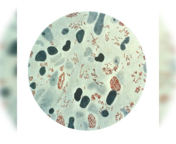 Bacilo de Hensen da lepra hanseníase