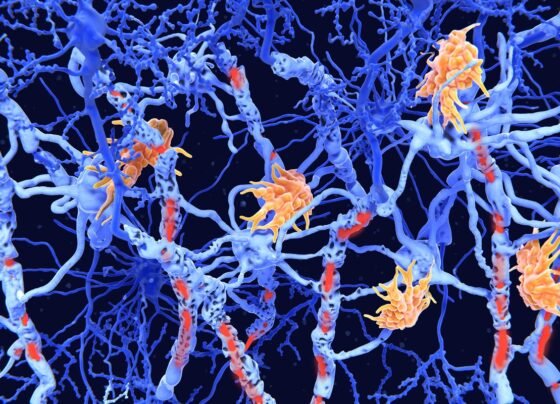 Ilustração de células nervosas danificadas pela doença degenerativa esclerose múltipla. Células do sistema imunológico (micróglia, laranja) atacaram as bainhas de mielina das células nervosas, resultando em danos à mielina (vermelho) e comprometimento da sinalização entre as células nervosas (neurônios, azul). Metrópoles