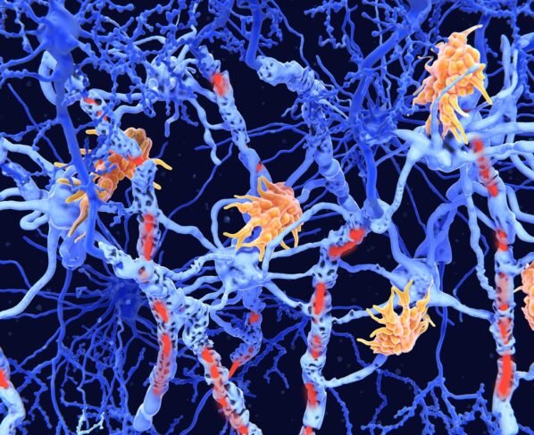 Ilustração de células nervosas danificadas pela doença degenerativa esclerose múltipla. Células do sistema imunológico (micróglia, laranja) atacaram as bainhas de mielina das células nervosas, resultando em danos à mielina (vermelho) e comprometimento da sinalização entre as células nervosas (neurônios, azul). Metrópoles