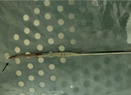 Menino que sentou em agulha de crochê cirurgia (1)