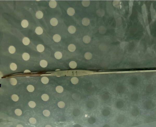 Menino que sentou em agulha de crochê cirurgia (1)