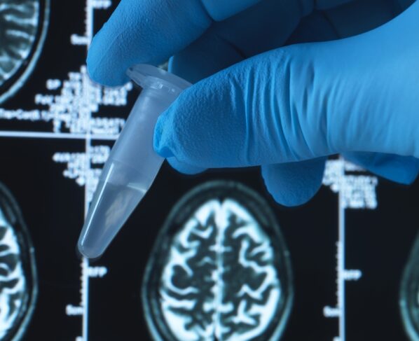 Foto colorida com raioX de cérebro humano ao fundo e mão humana com luvas azuis segurando uma pipeta com líquido transparente dentro. - Metrópoles.