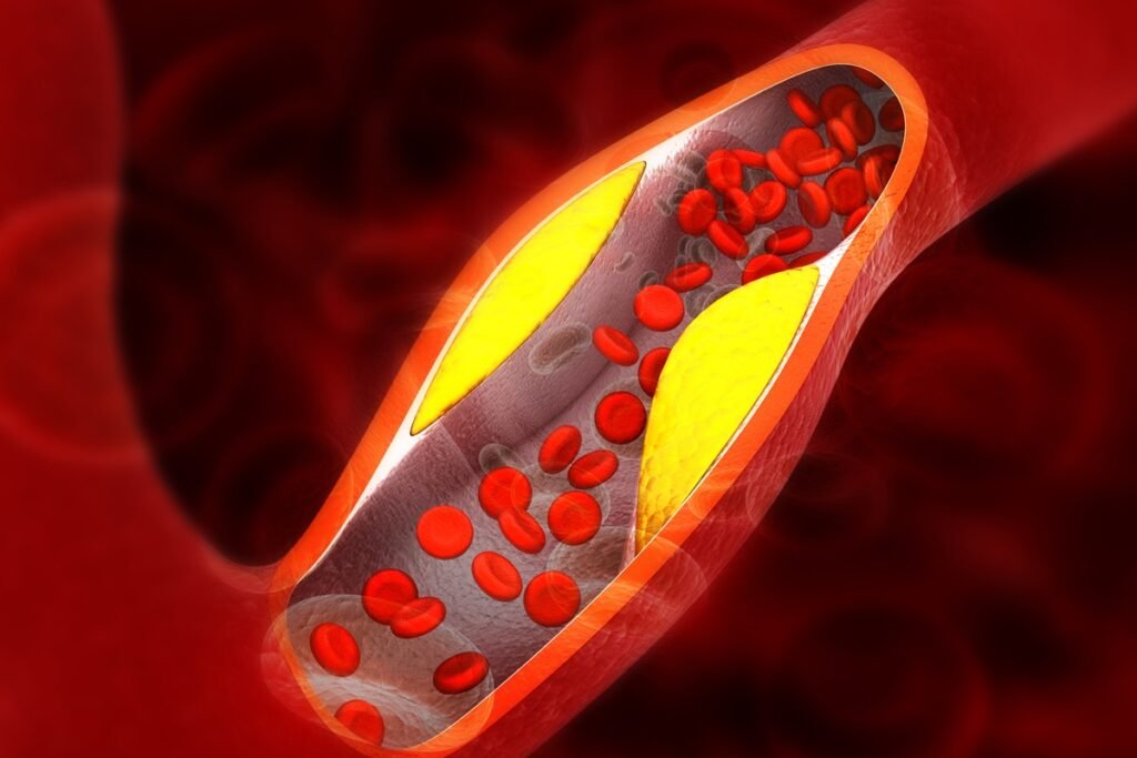 Ilustração colorida de artéria com placa de gordura - Cardiologistas explicam os principais sintomas de gordura nas artérias - Metrópoles