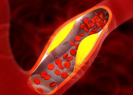 Ilustração colorida de artéria com placa de gordura - Cardiologistas explicam os principais sintomas de gordura nas artérias - Metrópoles