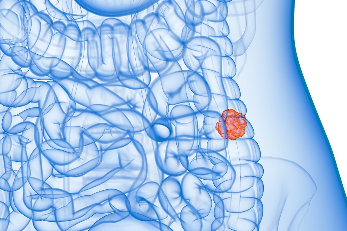Ilustração mostra massa vermelha no intestino, representando câncer - Metrópoles