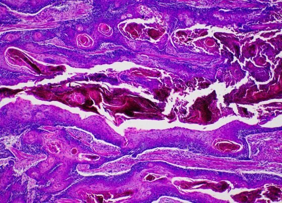 Imagem de microscópio mostra um câncer de pele não melanoma - Metrópoles