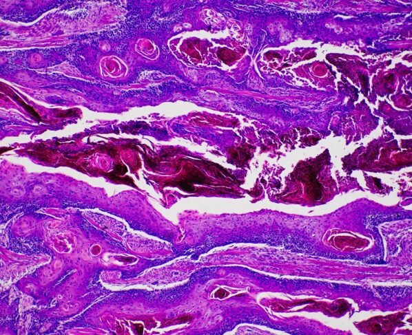 Imagem de microscópio mostra um câncer de pele não melanoma - Metrópoles