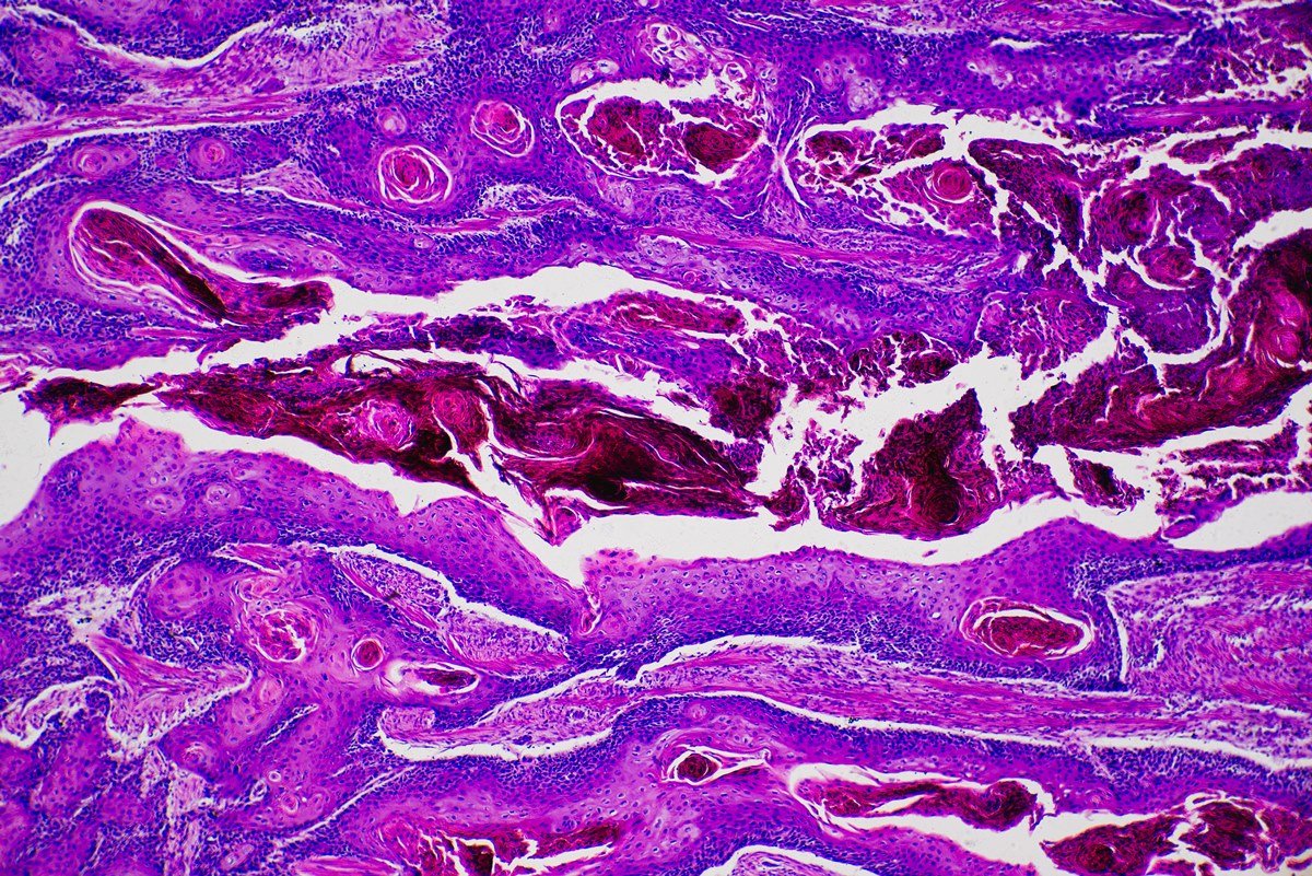 Imagem de microscópio mostra um câncer de pele não melanoma - Metrópoles