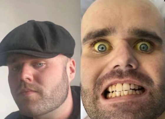 Imagem colorida mostra homem branco com os olhos amarelados - Metrópoles