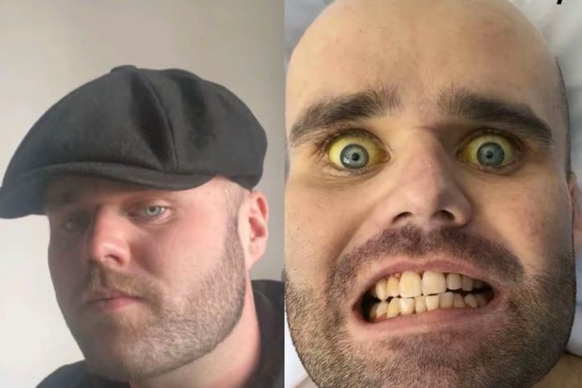 Imagem colorida mostra homem branco com os olhos amarelados - Metrópoles