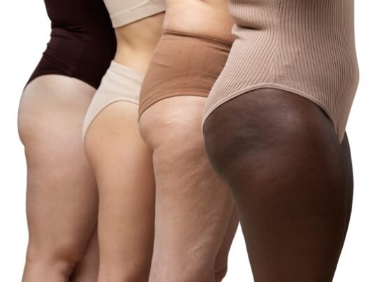 Imagem mostra o corpo de quatro mulheres que diferentes etnias. Conceito de lipedema. Metrópoles