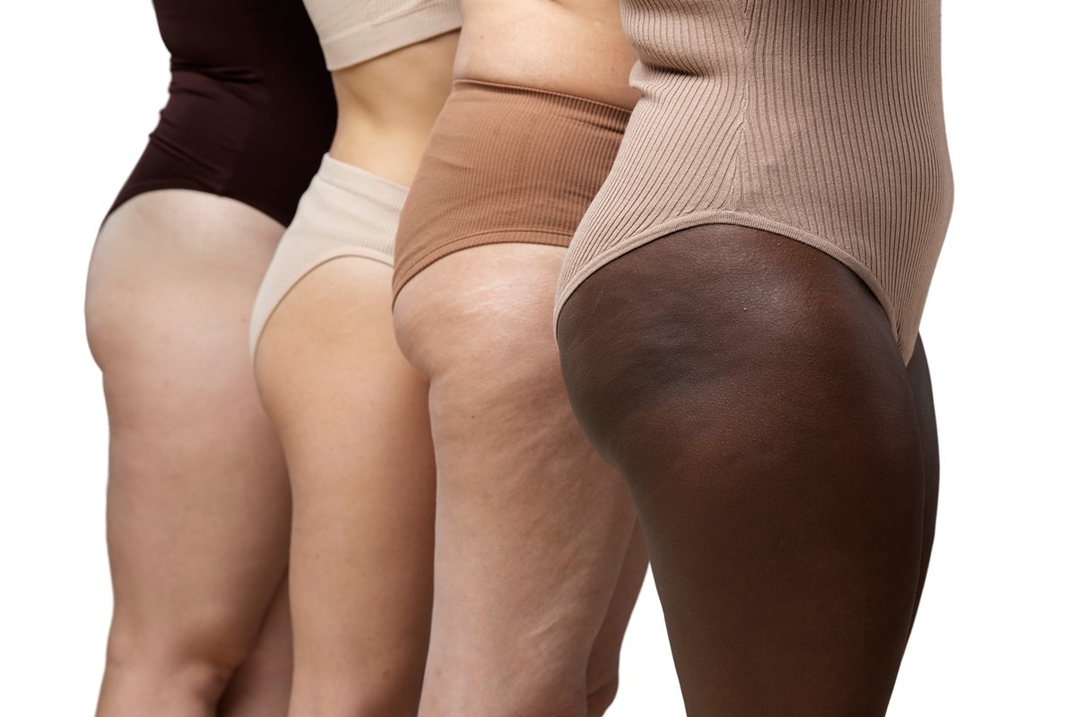 Imagem mostra o corpo de quatro mulheres que diferentes etnias. Conceito de lipedema. Metrópoles